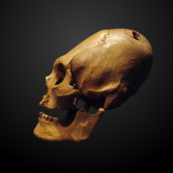 Deformed_trepanated_skull-ETHAM_019484-IMG_2346-gradient